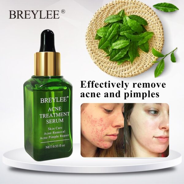 Acne Treatment Serum Face Facial Anti Acne Scar Removal Cream