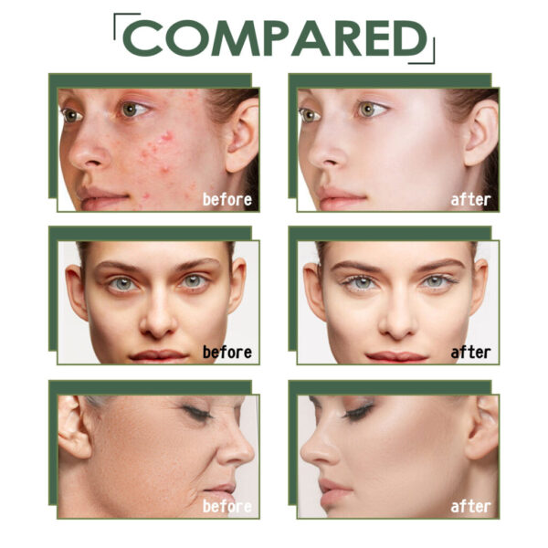 Acne Marks Blackhead Brightening Skin - Image 8