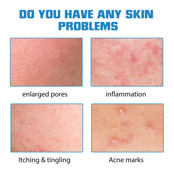 Hyaluronic Acid Replenishment - Image 5