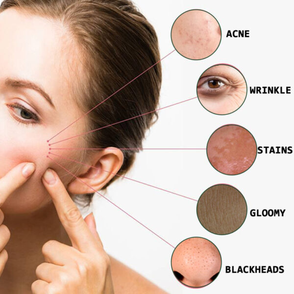 Acne Marks Blackhead Brightening Skin - Image 2