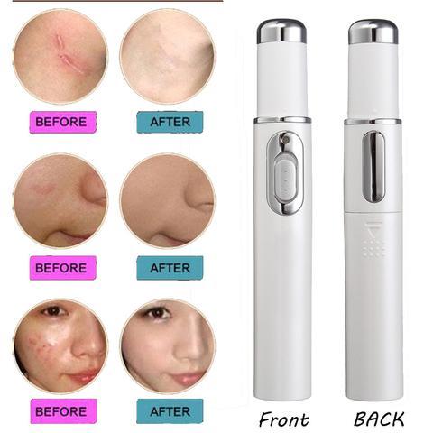 Blue Light Therapy Acne Laser Pen Soft Scar Wrinkle Removal - Image 3