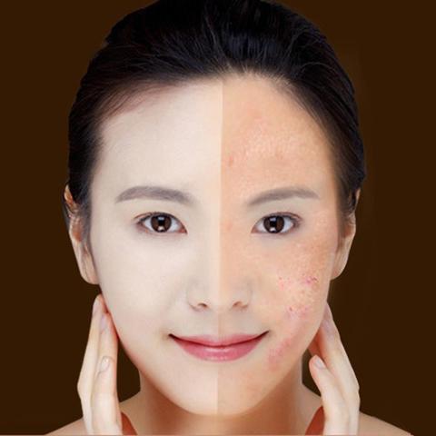 Blue Light Therapy Acne Laser Pen Soft Scar Wrinkle Removal - Image 8