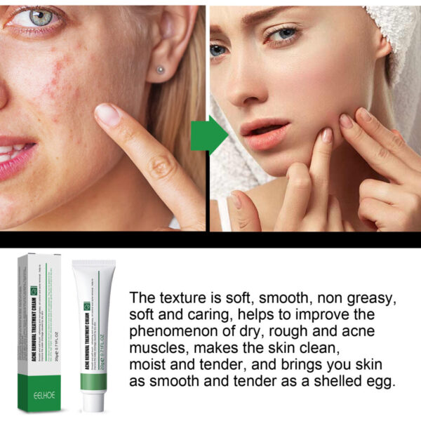 Blemish Cream Lightens Blemishes & Acne Brightens Skin Complexion
