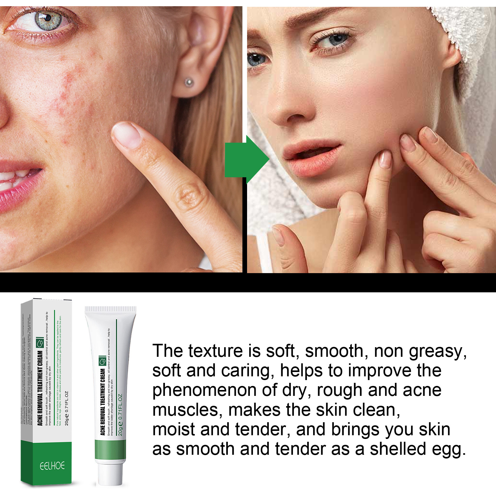 Blemish Cream Lightens Blemishes & Acne Brightens Skin Complexion